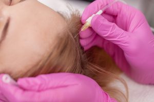 CARBOXITERAPIA CAPILAR MC360